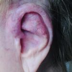 Ear malformation - before