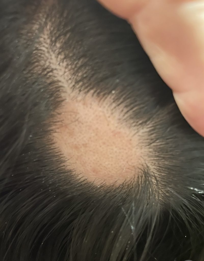 Alopecia Before Treatment