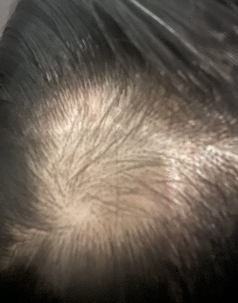 After alopecia treatment