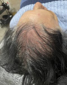 Image showing balding before hair loss treatment